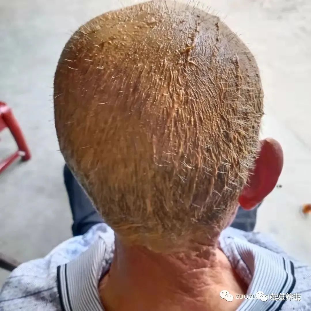 案例分享：85岁老人腿痛、无力，“种”发的案例