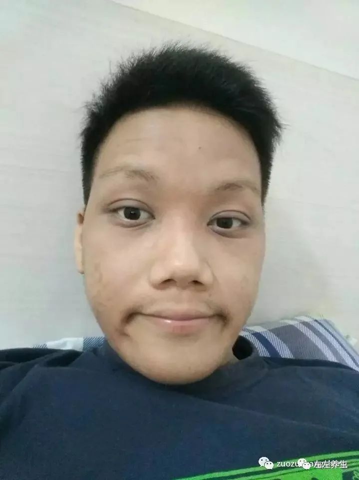 案例分享:马来西亚男孩严重湿疹、十天后大变样 案例分享:马来西亚男孩严重湿疹、十天后大变样