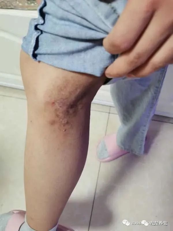 案例分享:学员李女士学习与践行自然疗法的心路历程 案例分享:学员李女士学习与践行自然疗法的心路历程