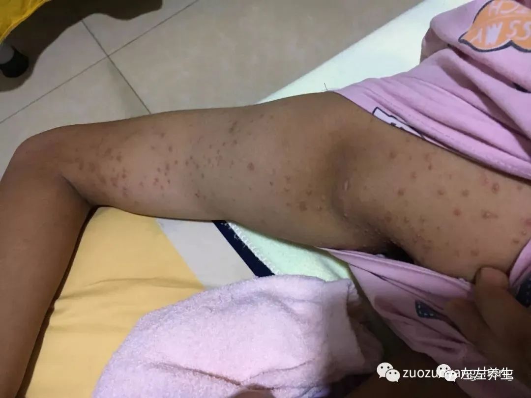 案例分享:14岁少年毛囊炎、全身痒、长痘痘的案例 案例分享:14岁少年毛囊炎、全身痒、长痘痘的案例