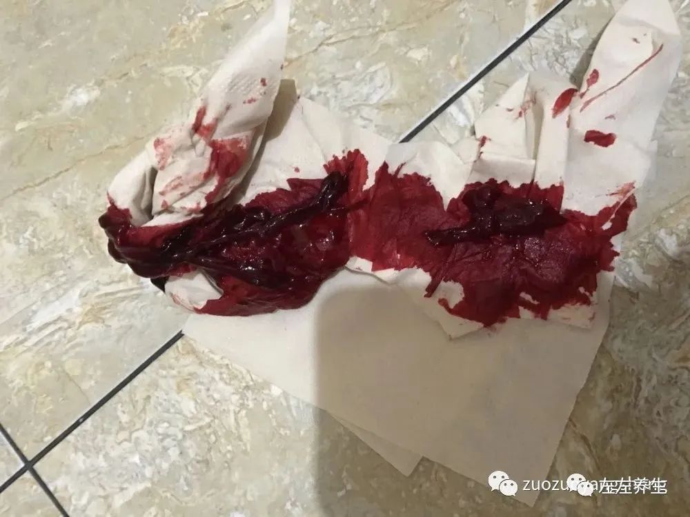 案例分享:子宫大出血调理案例 案例分享:子宫大出血调理案例