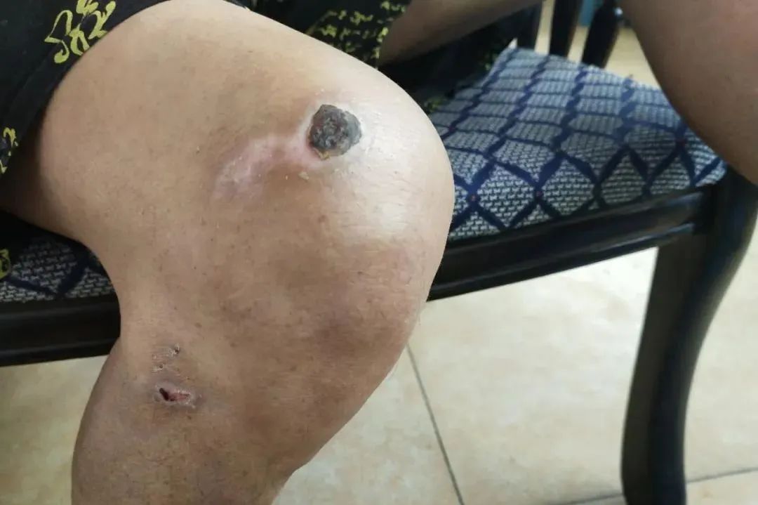 【原始点案例】原始点调理老人意外摔伤不能走路案例！