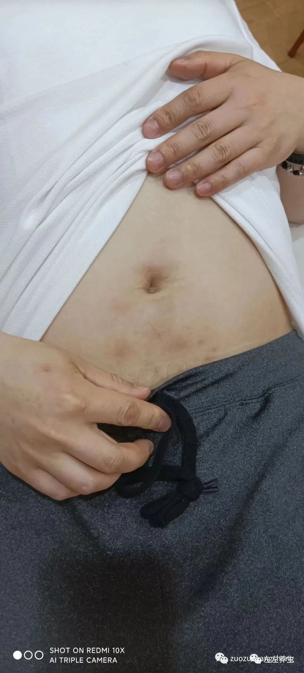 案例分享:腹部奇痒无比湿疹调理案例 案例分享:腹部奇痒无比湿疹调理案例