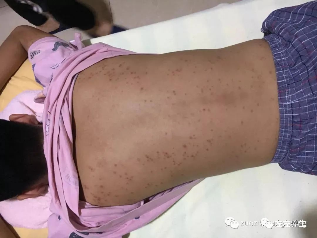 案例分享:14岁少年毛囊炎、全身痒、长痘痘的案例 案例分享:14岁少年毛囊炎、全身痒、长痘痘的案例