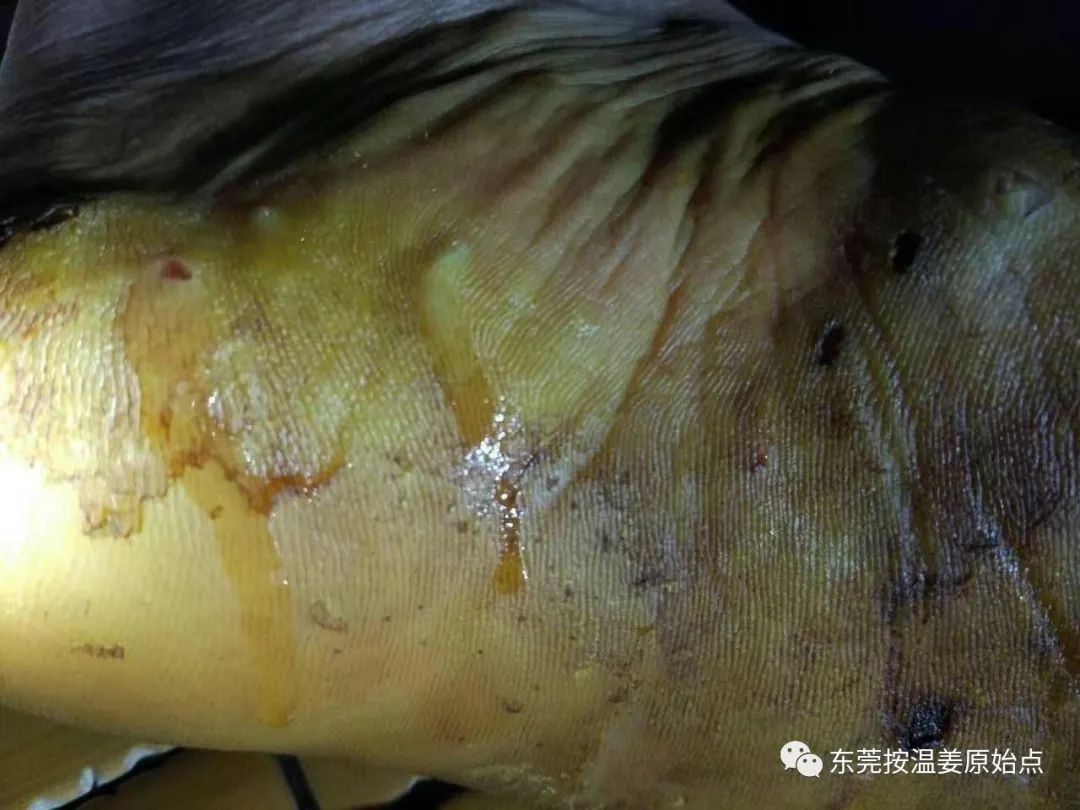 严重湿疹，真菌感染