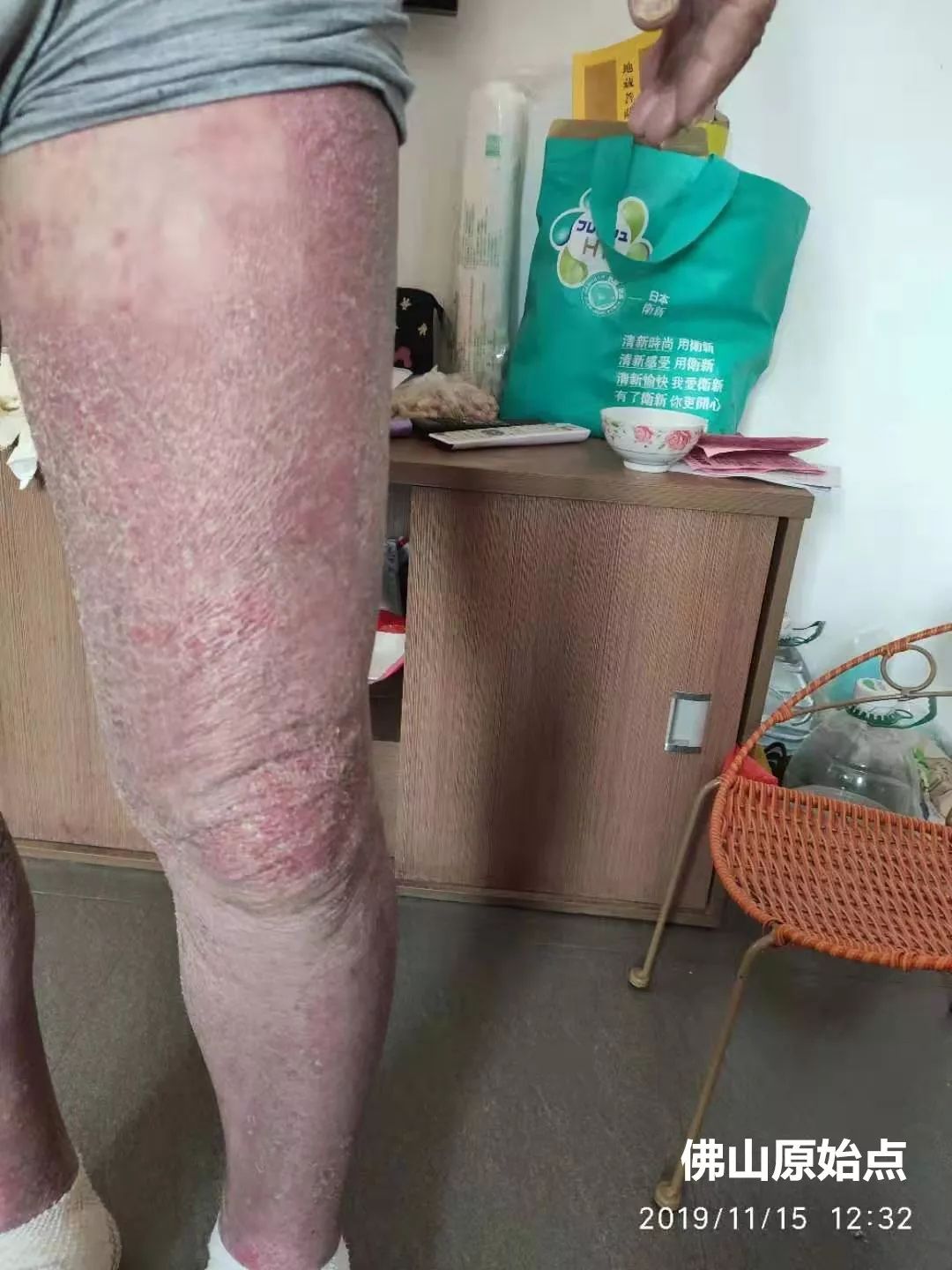 原始点调理十年牛皮癣案例