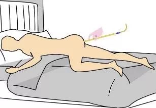 姜汤灌肠、姜粉泥灌肠、姜粉灌肠步骤（2020年更新版）