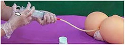 姜汤灌肠、姜粉泥灌肠、姜粉灌肠步骤（2020年更新版）