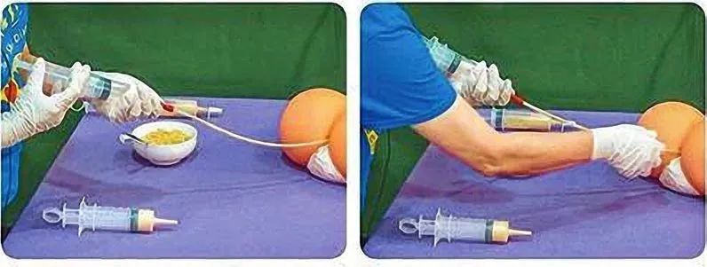 姜汤灌肠、姜粉泥灌肠、姜粉灌肠步骤（2020年更新版）