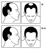 医圣故事丨石毛姜治“鬼剃头”