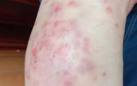 十年牛皮癣6个月基本恢复案例-七不姜 生姜养生网-明德CSA生态姜园&明安农业