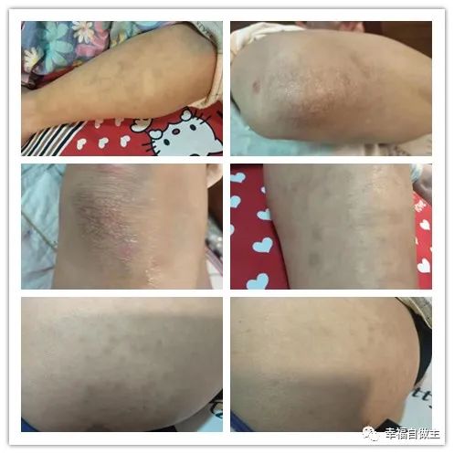 十年牛皮癣6个月基本恢复案例 十年牛皮癣6个月基本恢复案例
