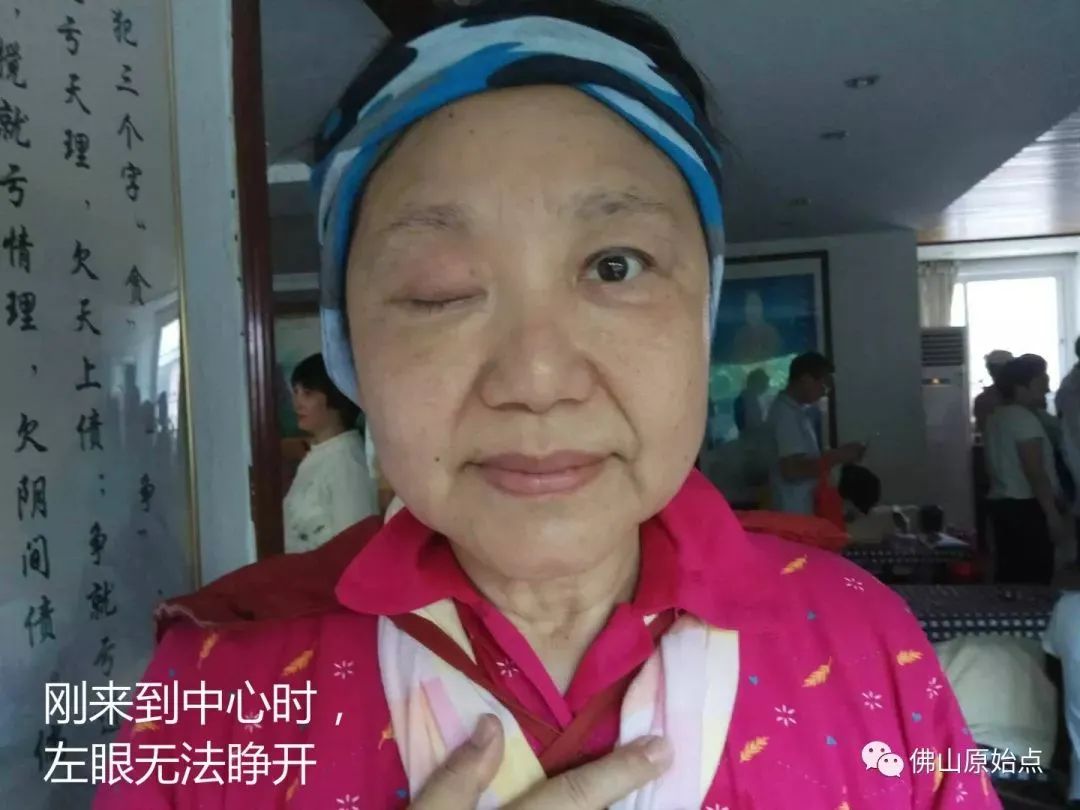 脑血管瘤致右眼无法睁开,原始点调理105天,生活完全恢复正常 脑血管瘤致右眼无法睁开,原始点调理105天,生活完全恢复正常