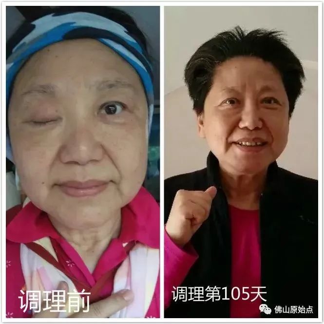 脑血管瘤致右眼无法睁开,原始点调理105天,生活完全恢复正常 脑血管瘤致右眼无法睁开,原始点调理105天,生活完全恢复正常