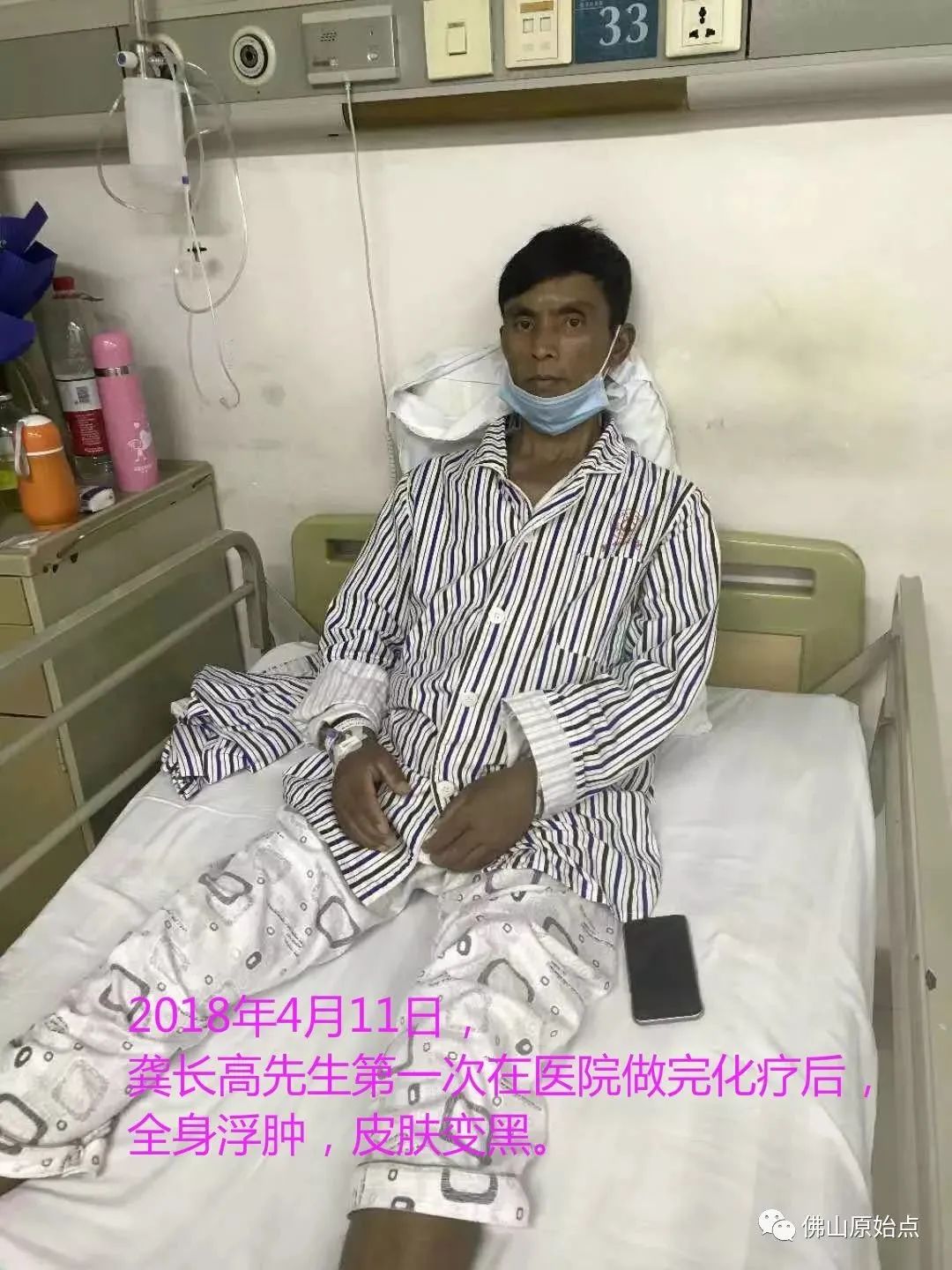 原始点调理浆细胞型巨大淋巴结增生病(CastIeman病)案例 原始点调理浆细胞型巨大淋巴结增生病(CastIeman病)案例