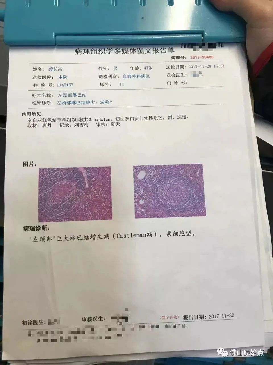 原始点调理浆细胞型巨大淋巴结增生病(CastIeman病)案例 原始点调理浆细胞型巨大淋巴结增生病(CastIeman病)案例