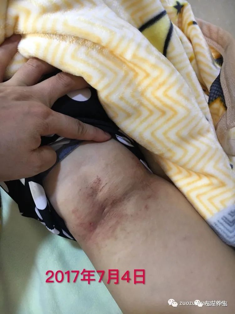 案例分享:全身奇痒无比的湿疹案例 案例分享:全身奇痒无比的湿疹案例