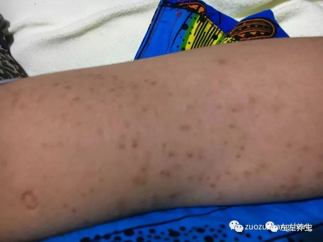 案例分享:14岁少年毛囊炎、全身痒、长痘痘的案例 案例分享:14岁少年毛囊炎、全身痒、长痘痘的案例