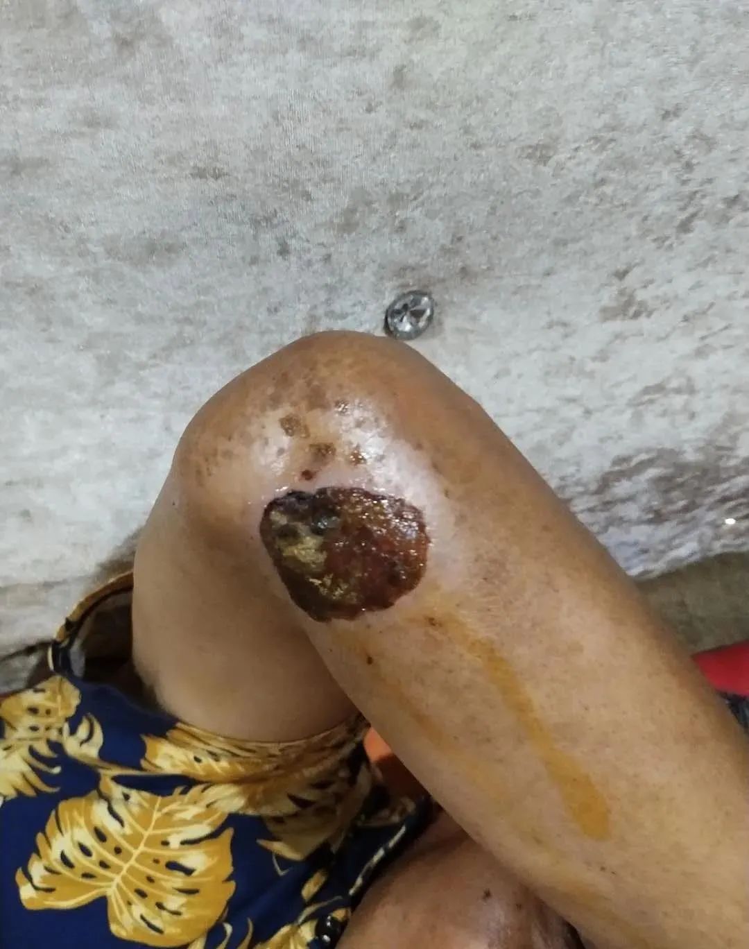 【原始点案例】原始点调理老人意外摔伤不能走路案例！