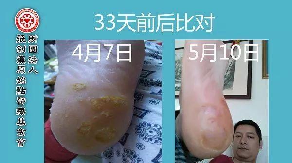 脚后跟鸡眼案例-七不姜 生姜养生网-明德CSA生态姜园&明安农业