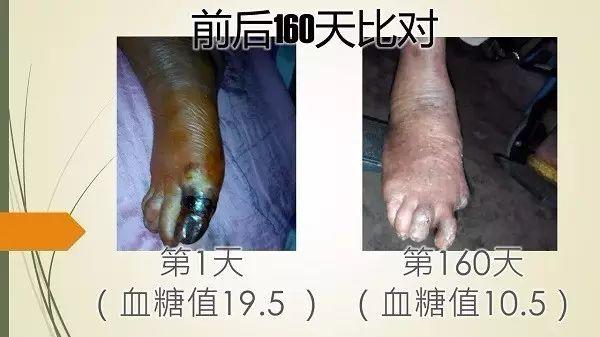 广西黑脚阿嫲(糖尿病)案例(简体版)-七不姜 生姜养生网-明德CSA生态姜园&明安农业