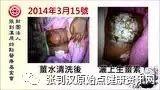 臀部烫伤案例(小孩)-七不姜 生姜养生网-明德CSA生态姜园&明安农业