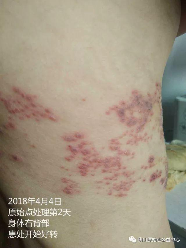 原始点调理带状疱疹：12天恢复+意外收获