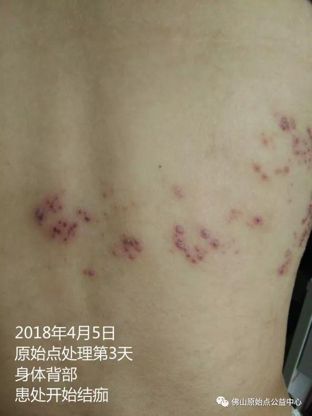 原始点调理带状疱疹：12天恢复+意外收获