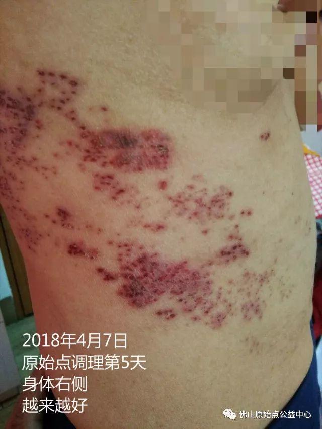 原始点调理带状疱疹：12天恢复+意外收获