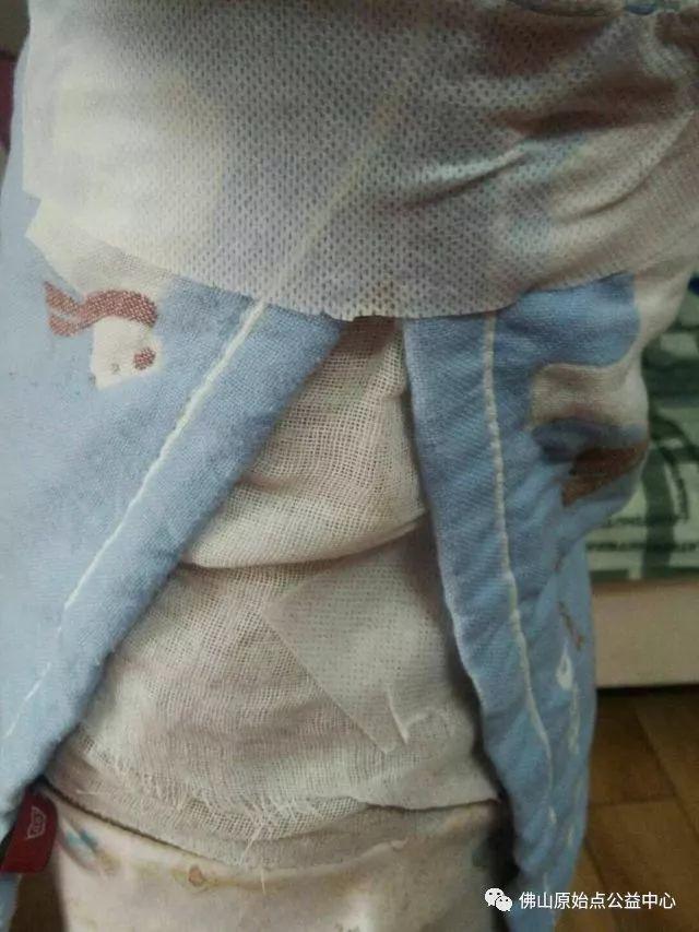 原始点调理带状疱疹：12天恢复+意外收获