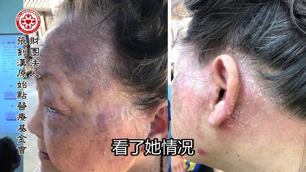 牛皮癣案例（美国）