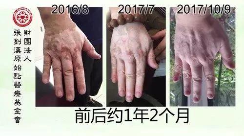 白癜风案例--2017.11最新案例-七不姜 生姜养生网-明德CSA生态姜园&明安农业