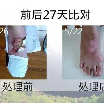脚部烫伤案例(热汤)(简体版)-七不姜 生姜养生网-明德CSA生态姜园&明安农业