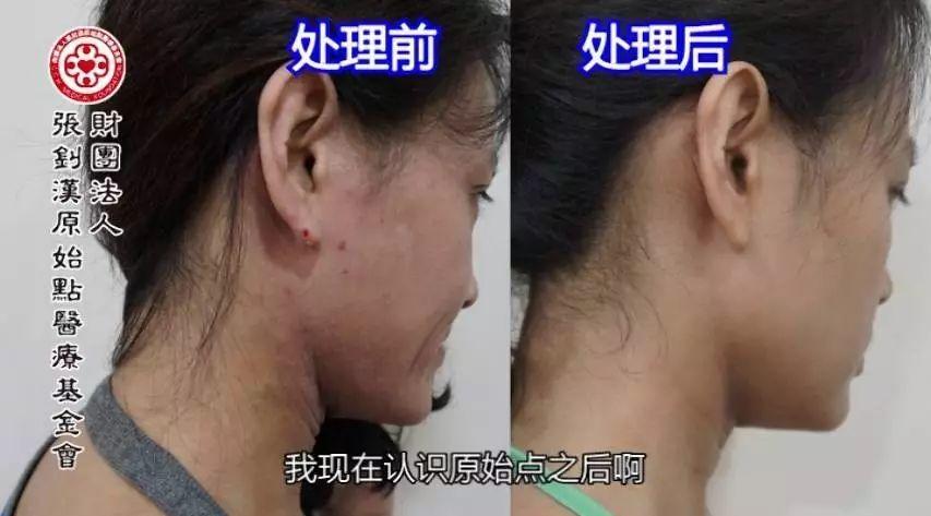 异位性皮肤炎案例(王小姐)(简体版)-2017.8最新案例-七不姜 生姜养生网-明德CSA生态姜园&明安农业