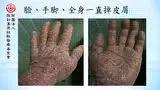 牛皮癣案例(日本人)(简体版)-七不姜 生姜养生网-明德CSA生态姜园&明安农业