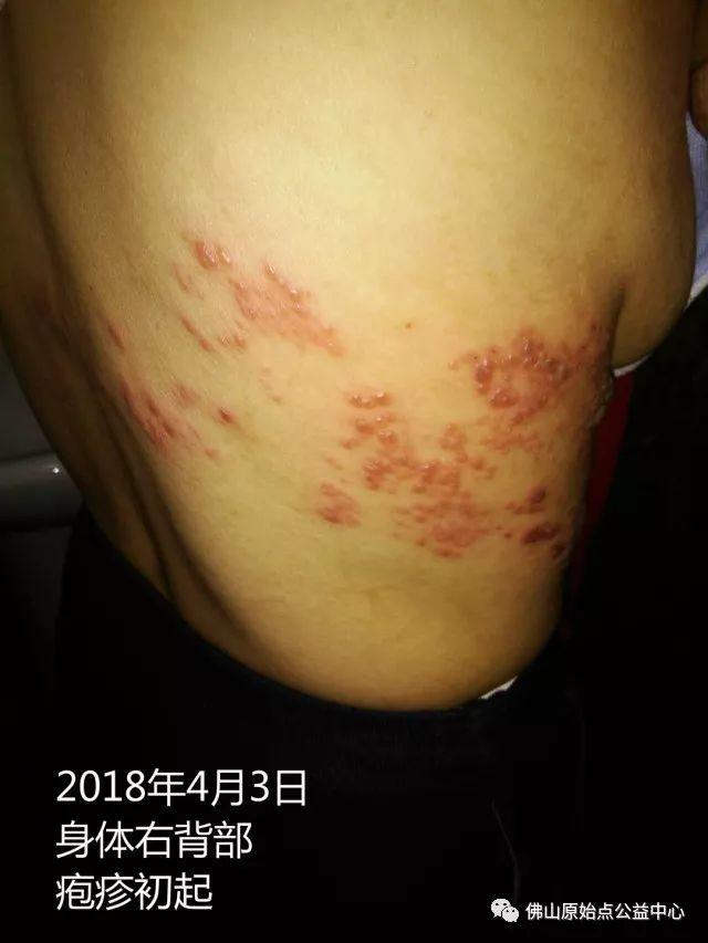 原始点调理带状疱疹：12天恢复+意外收获