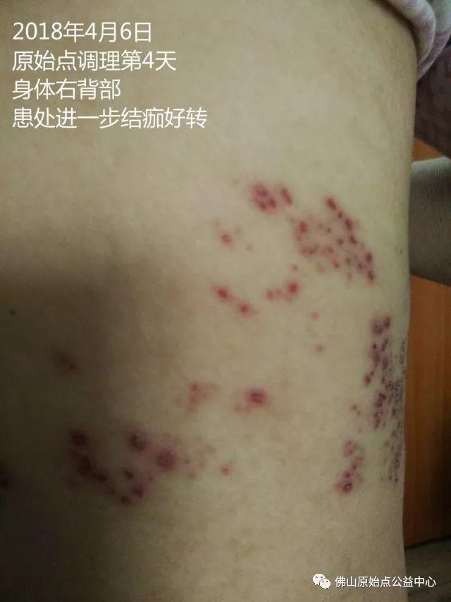 原始点调理带状疱疹：12天恢复+意外收获