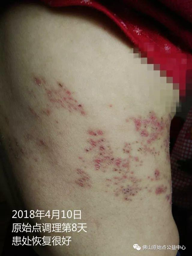 原始点调理带状疱疹：12天恢复+意外收获