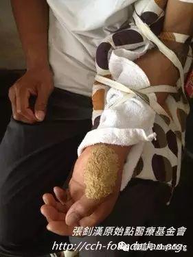 [經驗分享] 原始點應用分享-處理虎頭蜂螫傷