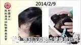头部烫伤案例(小孩)-七不姜 生姜养生网-明德CSA生态姜园&明安农业