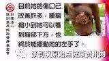 乳癌案例(46岁辛巴威)-七不姜 生姜养生网-明德CSA生态姜园&明安农业
