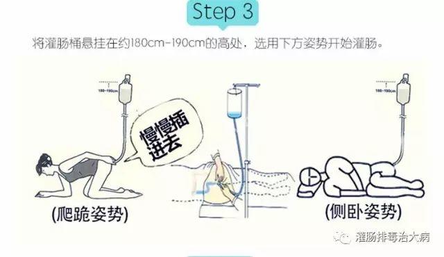 灌肠法常见问题解答 灌肠法常见问题解答