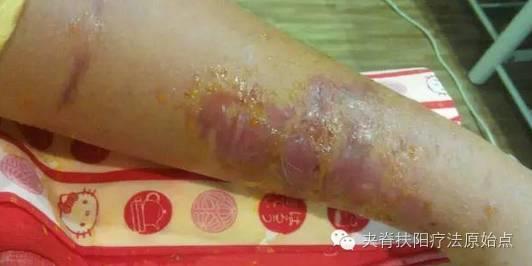 案例分享:原始点调理蛇毒的成功案例-七不姜 生姜养生网-明德CSA生态姜园&明安农业