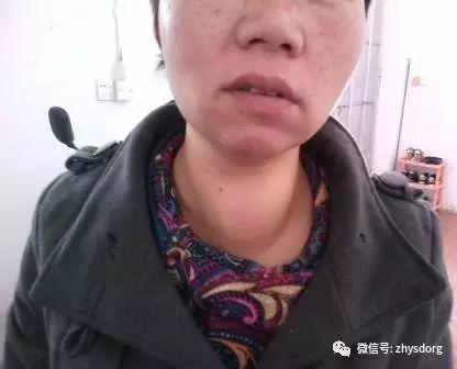 两个肿瘤案例对比背后的深思-七不姜 生姜养生网-明德CSA生态姜园&明安农业