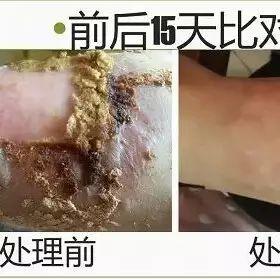 脚烫伤15天完全修复案例(简体版)-七不姜 生姜养生网-明德CSA生态姜园&明安农业
