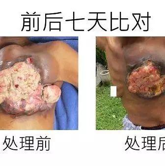 乳癌七天大幅改善案例(46岁辛巴威)(简体版)-七不姜 生姜养生网-明德CSA生态姜园&明安农业