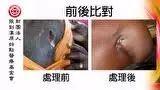 肩部溃烂案例(辛巴威)-七不姜 生姜养生网-明德CSA生态姜园&明安农业