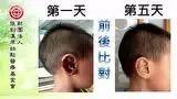 耳伤案例(小孩)-七不姜 生姜养生网-明德CSA生态姜园&明安农业