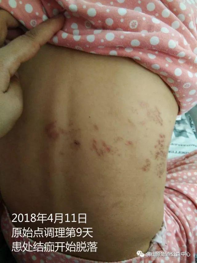 原始点调理带状疱疹：12天恢复+意外收获