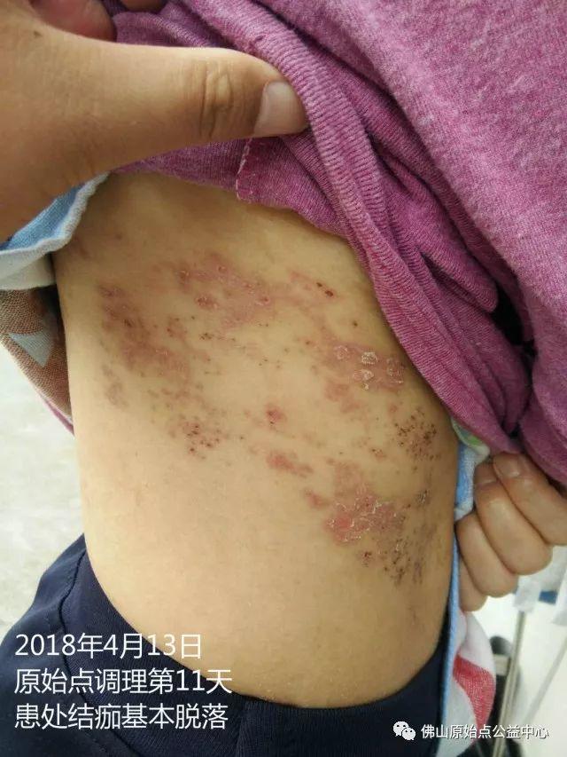 原始点调理带状疱疹：12天恢复+意外收获